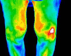 Thermal Image Arthritis