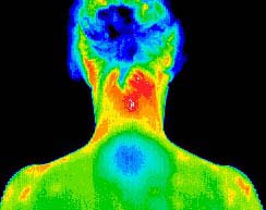 Thermal Image Auto Immune Fibromyalgia
