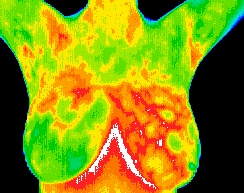 Thermal Image Breasts Fibrocystic