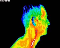 Thermal Image Carotid Artery Inflamed