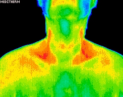 Thermal Image Hyperthyroid