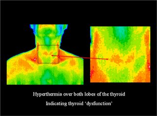 Thyroid Condition